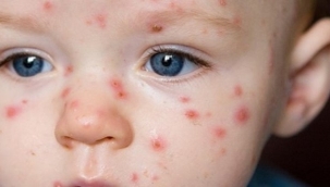 Kızamık vakaları artmaya başladı