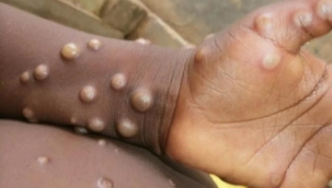 Prof. Dr. Bakır: ''M çiçeği virüsünde paniğe gerek yok''